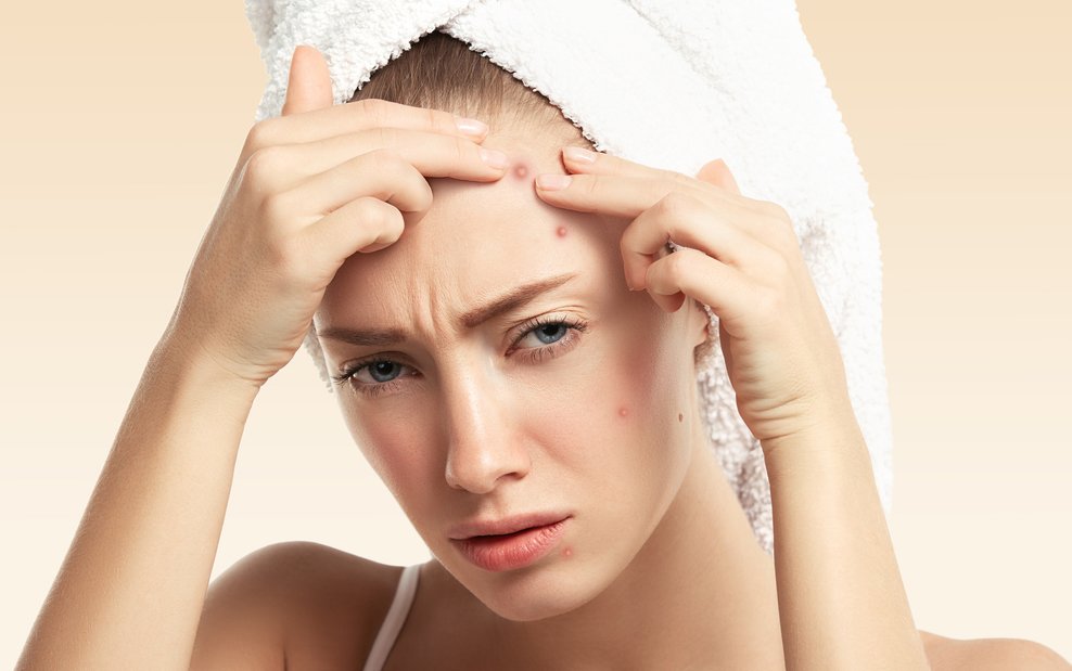causes de l'acné